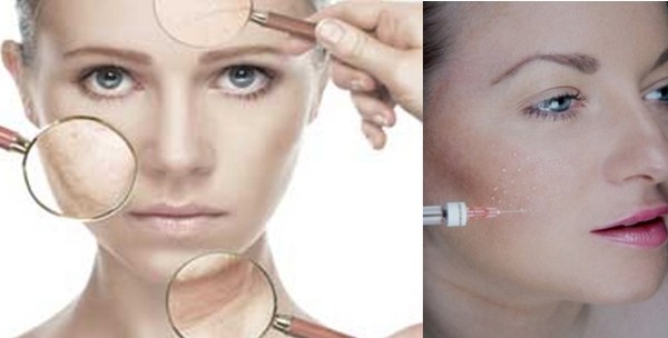 Une injection opérée au moyen de micro-canules en profondeur dans le derme. © brigittepailhes.wordpress.com Une injection opérée au moyen de micro-canules en profondeur dans le derme. © brigittepailhes.wordpress.com