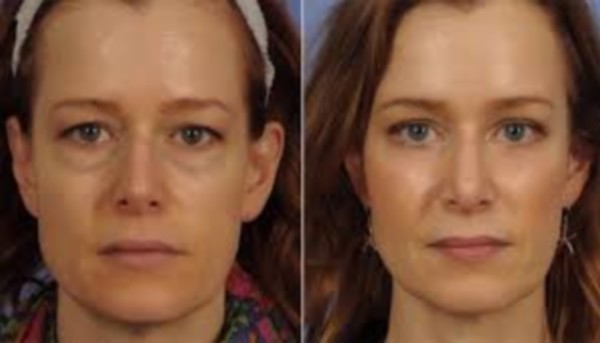 Blepharoplastie avant apres @ DR Blepharoplastie avant apres @ DR