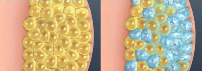 La technologie CoolSculpting® utilise le refroidissement contrôlé pour cibler et détruire uniquement ces cellules graisseuses - Photo gauche avant/droite Après - (Crédit photos DR) La technologie CoolSculpting® utilise le refroidissement contrôlé pour cibler et détruire uniquement ces cellules graisseuses - Photo gauche avant/droite Après - (Crédit photos DR)