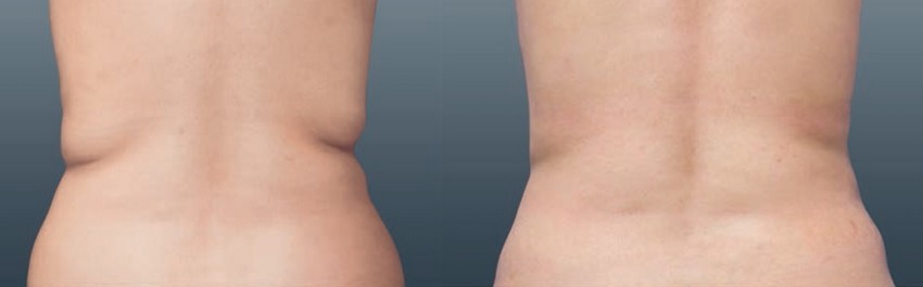 Coolsculpting®, une technologie sans chirurgie pour une silhouette rajeunie !